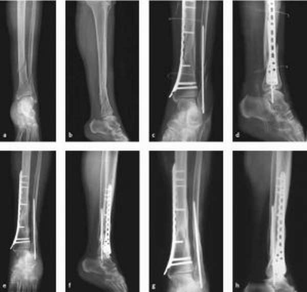 Рентген костей голени при переломе